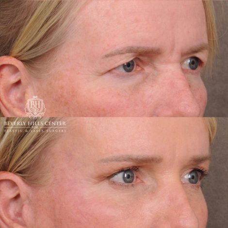 Beverly Hills Center Female Patient Before and After AuraLyft™, featuring the Cupid Lift™ Corner Lift, Temporal Brow Reset, and Fat Grafting
