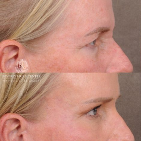 Beverly Hills Center Female Patient Before and After AuraLyft™, featuring the Cupid Lift™ Corner Lift, Temporal Brow Reset, and Fat Grafting