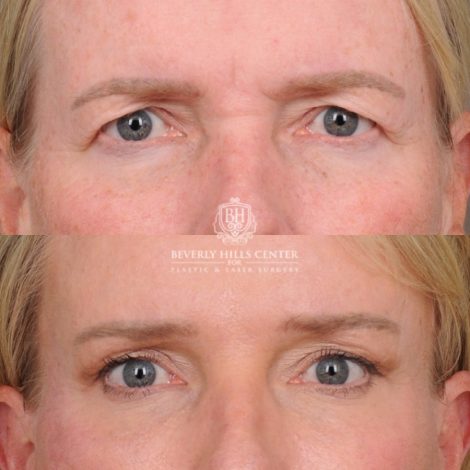 Beverly Hills Center Female Patient Before and After AuraLyft™, featuring the Cupid Lift™ Corner Lift, Temporal Brow Reset, and Fat Grafting