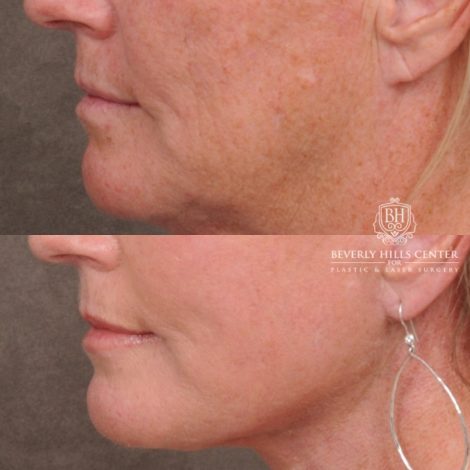 Beverly Hills Center Female Patient Before and After AuraLyft™, featuring the Cupid Lift™ Corner Lift, Temporal Brow Reset, and Fat Grafting