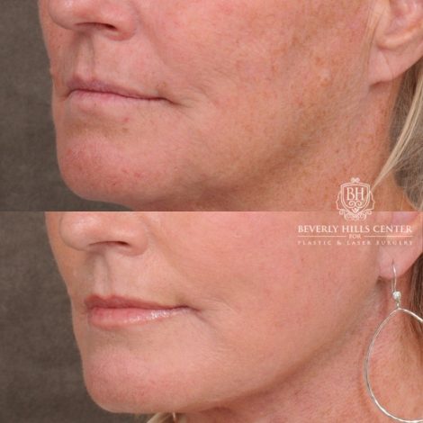 Beverly Hills Center Female Patient Before and After AuraLyft™, featuring the Cupid Lift™ Corner Lift, Temporal Brow Reset, and Fat Grafting