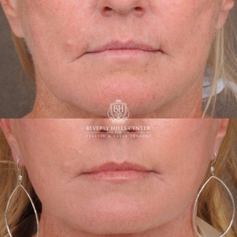 Beverly Hills Center Female Patient Before and After AuraLyft™, featuring the Cupid Lift™ Corner Lift, Temporal Brow Reset, and Fat Grafting