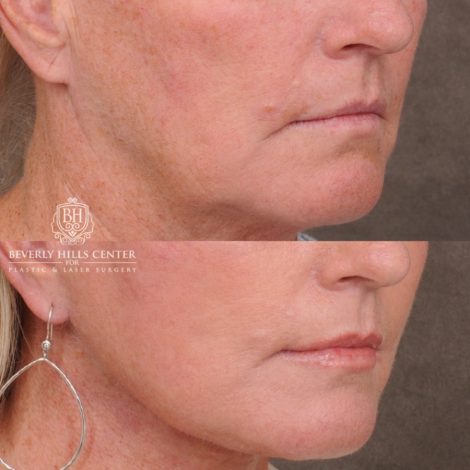 Beverly Hills Center Female Patient Before and After AuraLyft™, featuring the Cupid Lift™ Corner Lift, Temporal Brow Reset, and Fat Grafting