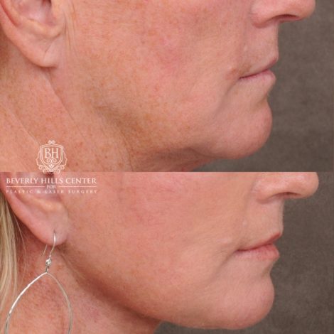 Beverly Hills Center Female Patient Before and After AuraLyft™, featuring the Cupid Lift™ Corner Lift, Temporal Brow Reset, and Fat Grafting