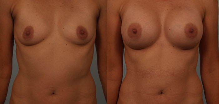 Before and after images of a person's torso showing breast augmentation results, with fuller breasts in the after image.
