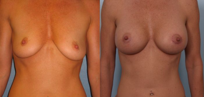 Before and after images of a person's torso showing changes in breast size due to augmentation.