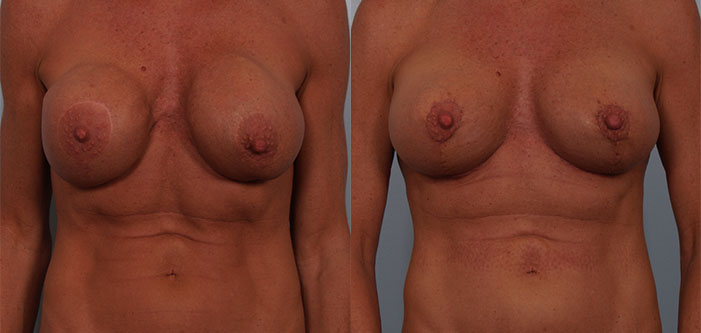 Before and after images showing a person's chest with visible differences in breast shape and size.