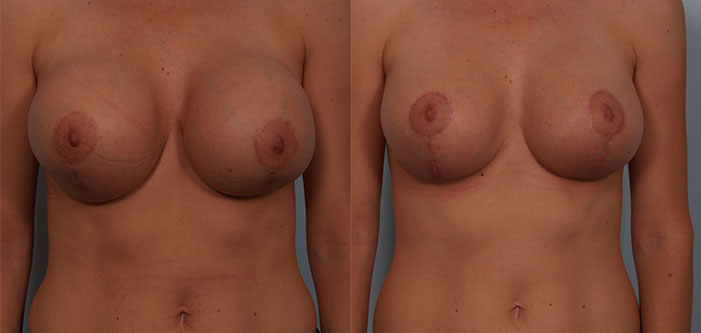 Before and after images of a person who underwent breast reduction surgery, showing difference in breast size and shape.