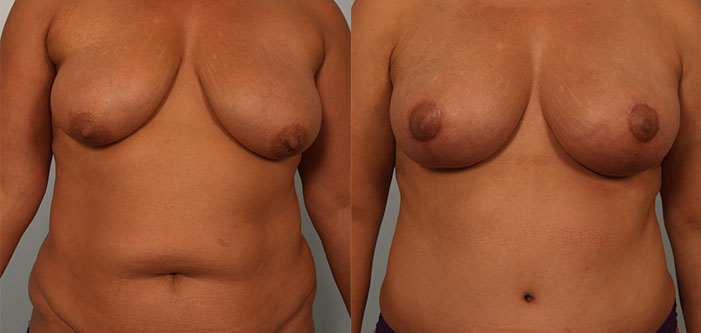 Two side-by-side photos show a person's torso before and after cosmetic surgery, highlighting changes in breast shape and abdominal contour.