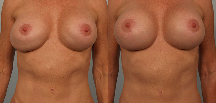 Two side-by-side comparison images show a person's upper torso, highlighting changes in breast size and shape.