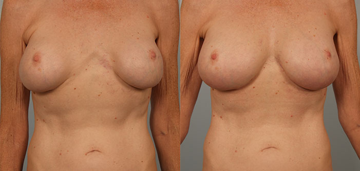 Before and after images of a person showing breast reconstruction results, with visible surgical scars.