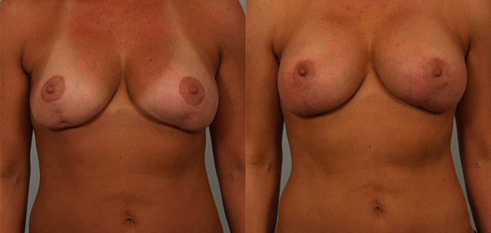 Before and after photos of a person showing the results of breast augmentation surgery. The left image shows smaller breasts, and the right image displays larger, rounder breasts.