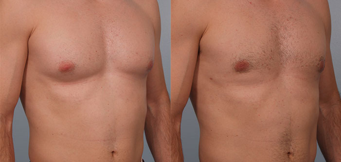 Side-by-side comparison of a male torso before and after a surgical procedure, showing visible chest contouring changes.
