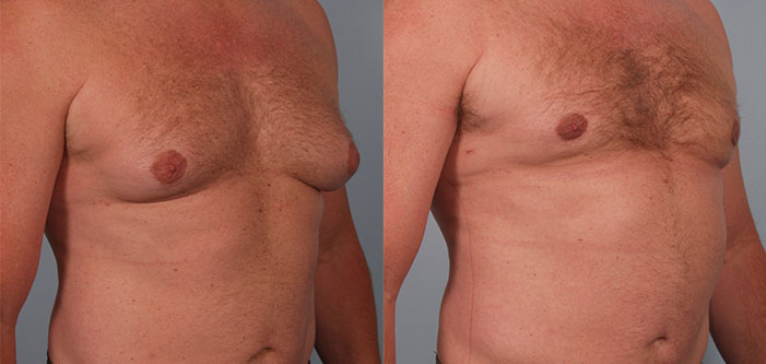 Two side-by-side photos of a male torso before and after a chest transformation, showing reduced chest protrusion and contouring differences.