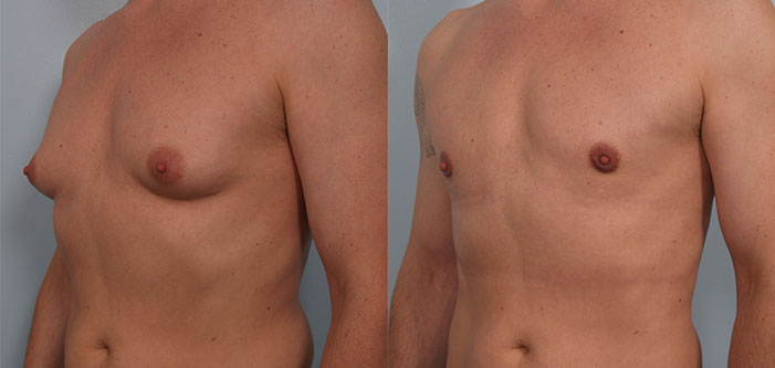 Two side-by-side images of a man's chest, showing a before and after comparison of a surgical procedure. The left image shows raised tissue, while the right shows a flatter appearance.
