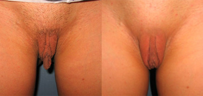 Before and after images of a surgical procedure on the labia show the changes in shape and size.