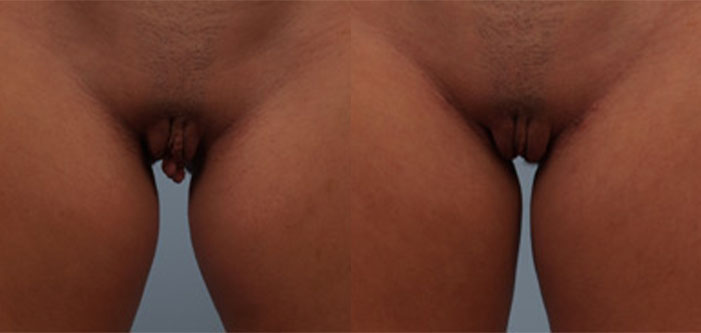 Close-up comparison of a person's groin area before and after a surgical procedure, showing visible changes in skin appearance and structure.