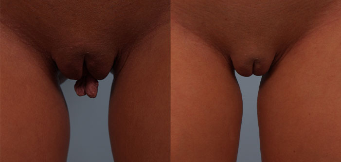 Side-by-side comparison showing before and after images of labiaplasty, illustrating noticeable changes in labia size and shape.