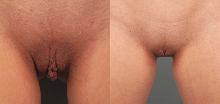 Before and after images showing the results of a labiaplasty procedure.