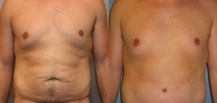 Before and after image of a man showing body transformation focused on the torso area, highlighting a reduction in weight or fat.