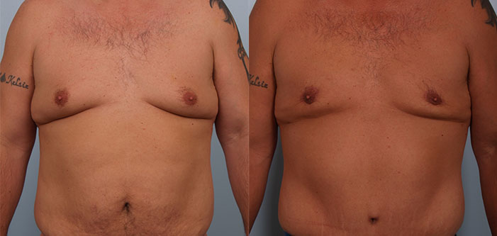 Before and after image of a person’s torso showing changes in chest contour, with tattoos visible on both arms.