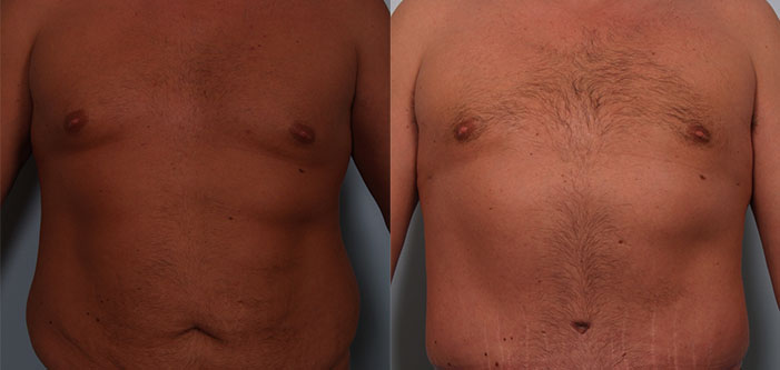 Before and after image of a man's torso showing surgical changes; the left side is before surgery with looser skin, and the right side is after surgery with tighter skin.