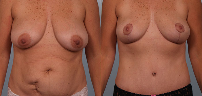 Two side-by-side photos show the same person before and after a plastic surgery procedure, highlighting changes in breast shape and abdominal contour.