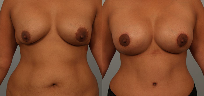 Before and after images of a woman's torso showing the results of breast augmentation with noticeable changes in size and shape.