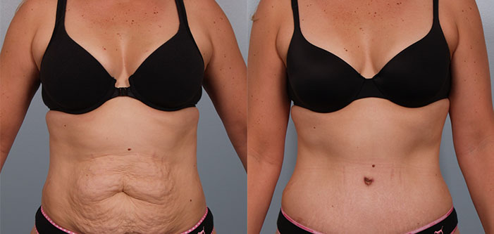 Before-and-after comparison of a person showing a front view. The left image depicts loose skin on the abdomen; the right image shows a smoother abdominal area post-surgery.