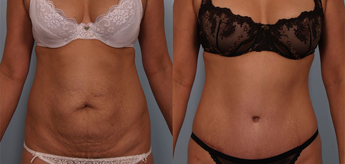Two side-by-side images showing a woman's abdomen before and after a body contouring procedure, showcasing a smoother and more toned appearance in the after image.