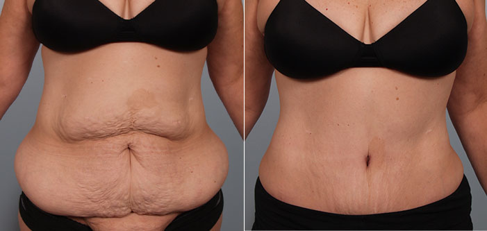 Before and after photo showing a woman’s abdomen. Left: Loose skin and excess tissue; right: smoother contoured appearance post-procedure.
