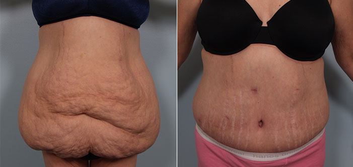 Before and after photos showing a person's abdomen. The left image shows loose, excess skin; the right image shows the area tightened and smoothed post-surgery.