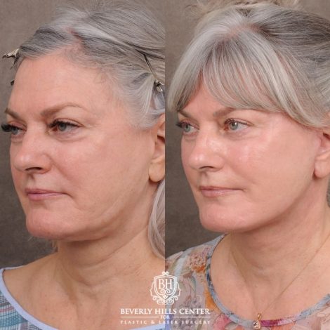 Beverly Hills Center Female Patient Before and After AuraLyft, Cupid Lift® Corner Lift, Fat Grafting