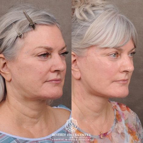 Beverly Hills Center Female Patient Before and After AuraLyft, Cupid Lift® Corner Lift, Fat Grafting