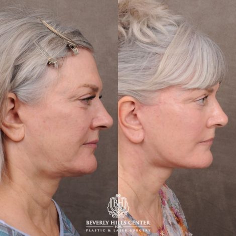 Beverly Hills Center Female Patient Before and After AuraLyft, Cupid Lift® Corner Lift, Fat Grafting