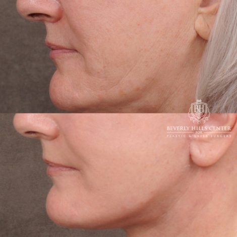 Beverly Hills Center Female Patient Before and After AuraLyft, Cupid Lift® Corner Lift, Fat Grafting