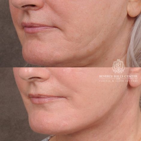 Beverly Hills Center Female Patient Before and After AuraLyft, Cupid Lift® Corner Lift, Fat Grafting