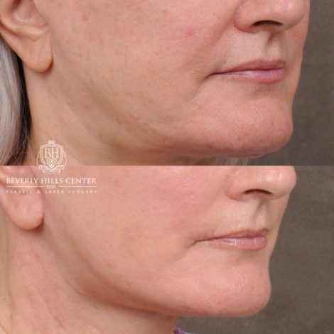 Beverly Hills Center Female Patient Before and After AuraLyft, Cupid Lift® Corner Lift, Fat Grafting