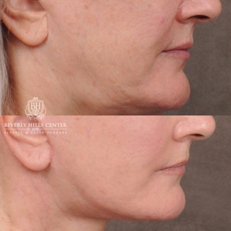 Beverly Hills Center Female Patient Before and After AuraLyft, Cupid Lift® Corner Lift, Fat Grafting