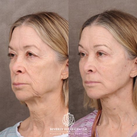Beverly Hills Center Female Patient Before and After AuraLyft, Upper Blepharoplasty, Minor Cupid Lift®, Fat Grafting