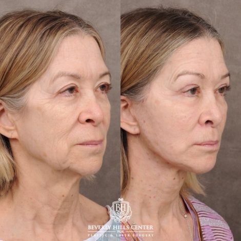 Beverly Hills Center Female Patient Before and After AuraLyft, Upper Blepharoplasty, Minor Cupid Lift®, Fat Grafting