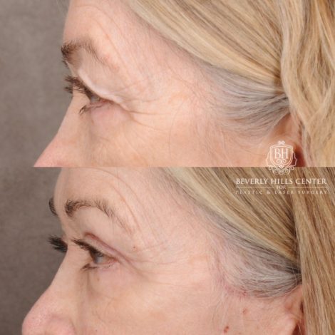 Beverly Hills Center Female Patient Before and After AuraLyft, Upper Blepharoplasty, Minor Cupid Lift®, Fat Grafting