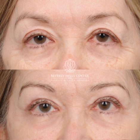Beverly Hills Center Female Patient Before and After AuraLyft, Upper Blepharoplasty, Minor Cupid Lift®, Fat Grafting