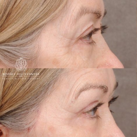 Beverly Hills Center Female Patient Before and After AuraLyft, Upper Blepharoplasty, Minor Cupid Lift®, Fat Grafting