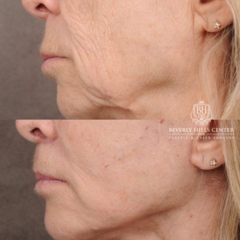 Beverly Hills Center Female Patient Before and After AuraLyft, Upper Blepharoplasty, Minor Cupid Lift®, Fat Grafting