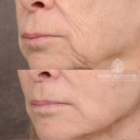 Beverly Hills Center Female Patient Before and After AuraLyft, Upper Blepharoplasty, Minor Cupid Lift®, Fat Grafting