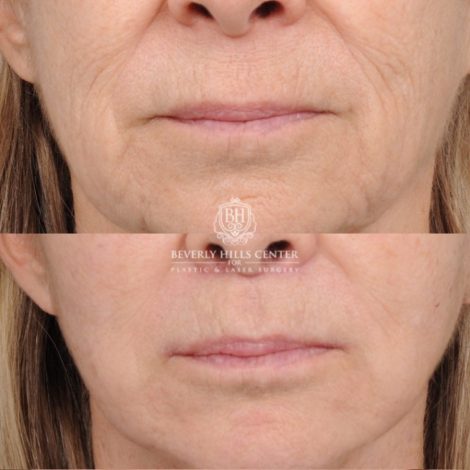 Beverly Hills Center Female Patient Before and After AuraLyft, Upper Blepharoplasty, Minor Cupid Lift®, Fat Grafting