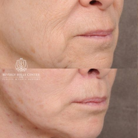 Beverly Hills Center Female Patient Before and After AuraLyft, Upper Blepharoplasty, Minor Cupid Lift®, Fat Grafting
