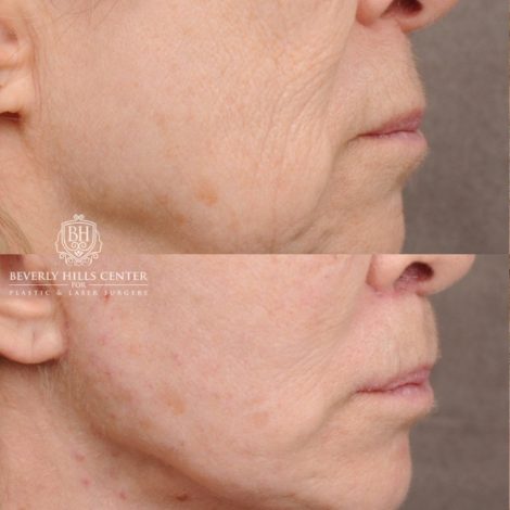 Beverly Hills Center Female Patient Before and After AuraLyft, Upper Blepharoplasty, Minor Cupid Lift®, Fat Grafting