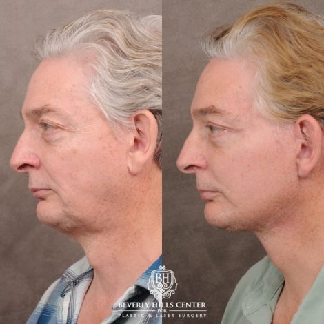 Beverly Hills Center Male Patient Before and After AuraLyft, Lateral Brow, Upper Blepharoplasty